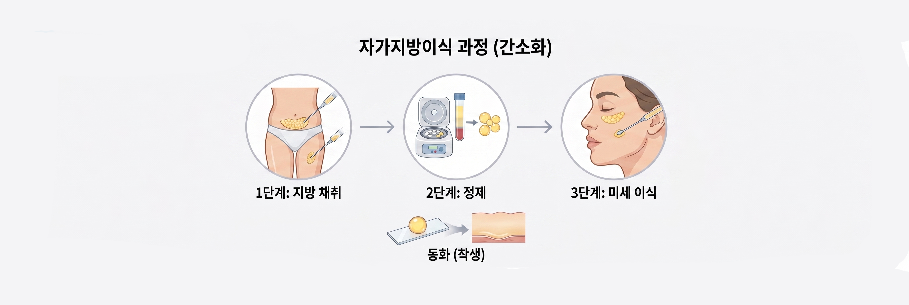 자가지방이식 프로세스 이미지